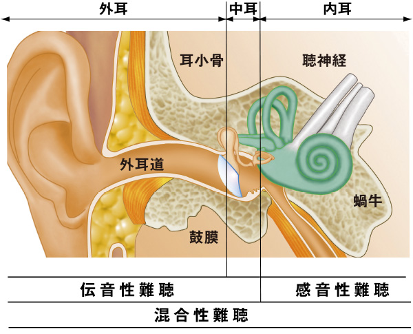 難聴の種類